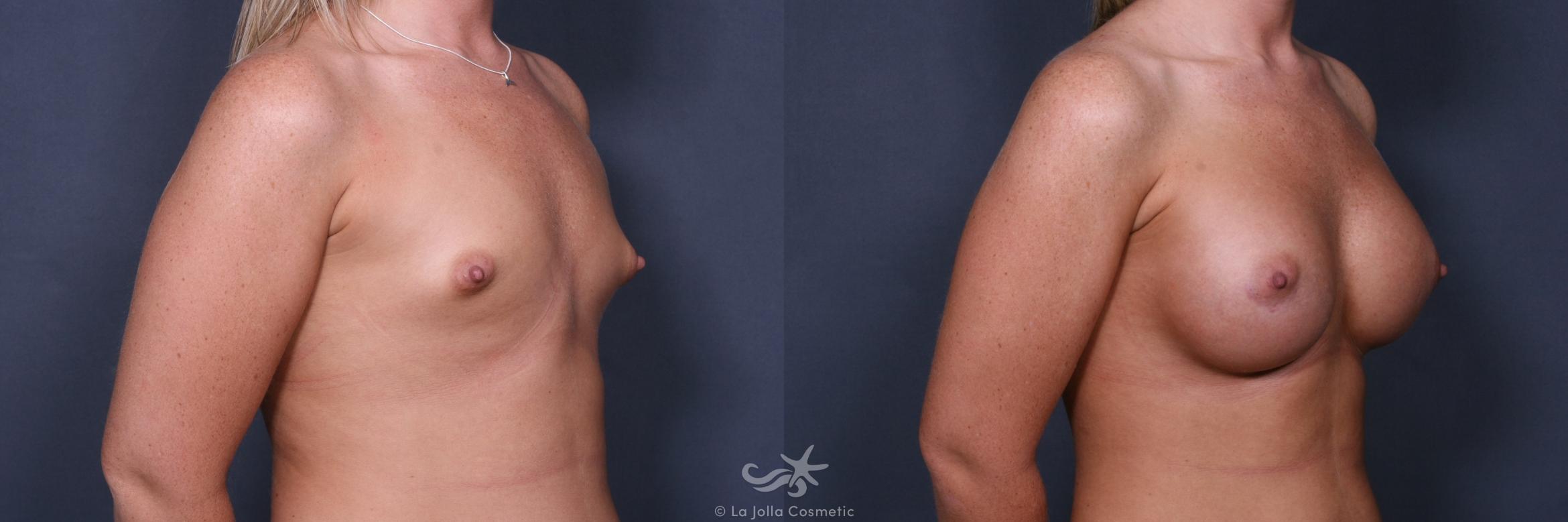 Before & After Breast Augmentation Result 529 Right Oblique View in San Diego, CA