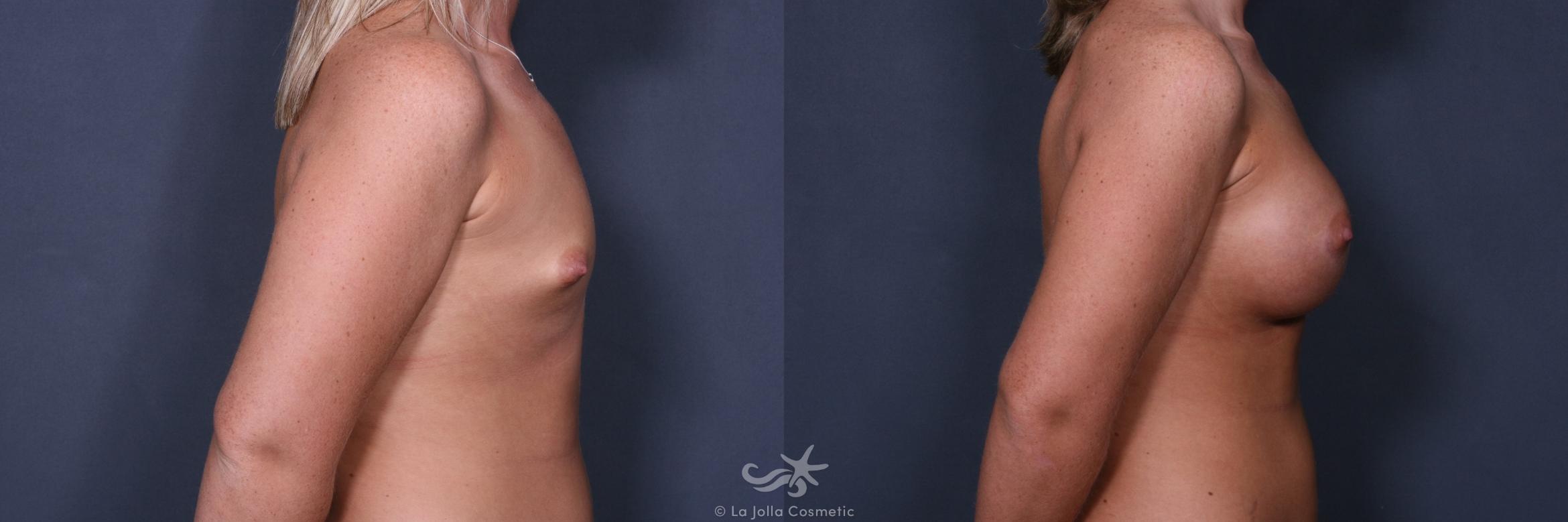 Before & After Breast Augmentation Result 529 Right Side View in San Diego, CA