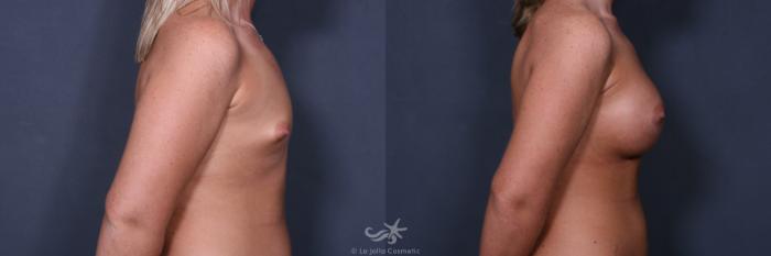 Before & After Breast Augmentation Result 529 Right Side View in San Diego, Carlsbad, CA
