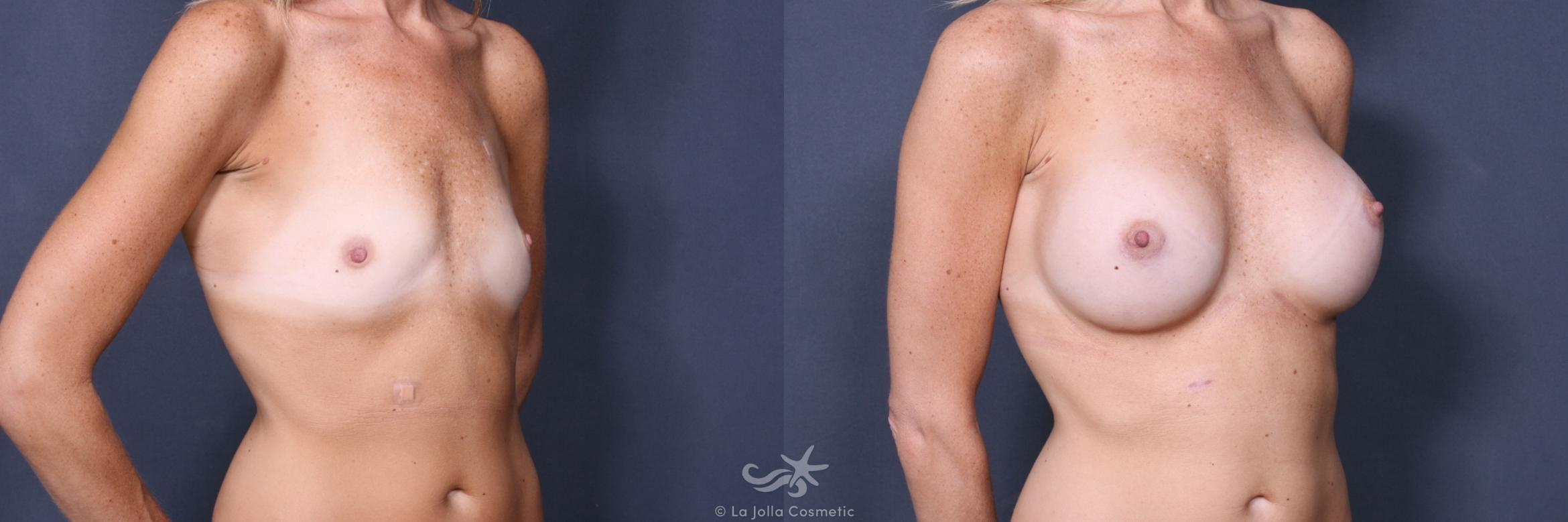 Before & After Breast Augmentation Result 532 Right Oblique View in San Diego, CA
