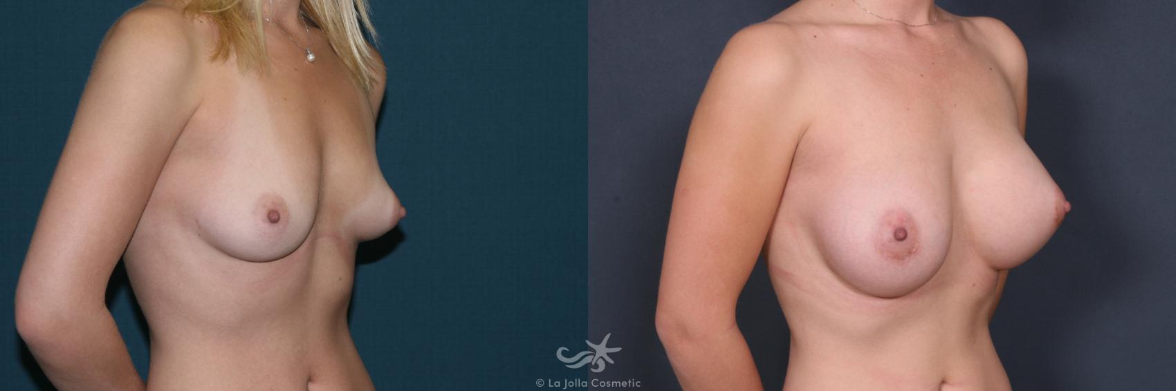 Before & After Breast Augmentation Result 534 Right Oblique View in San Diego, CA