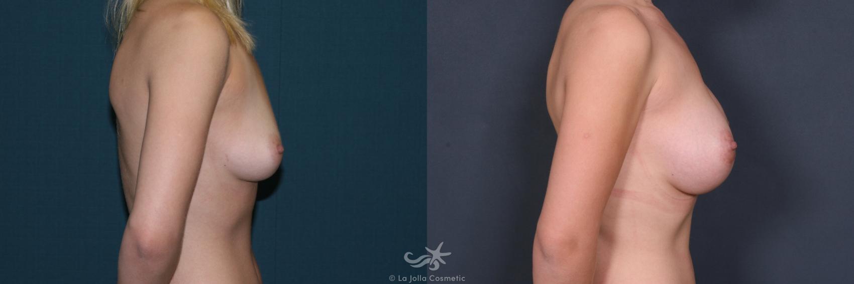 Before & After Breast Augmentation Result 534 Right Side View in San Diego, CA