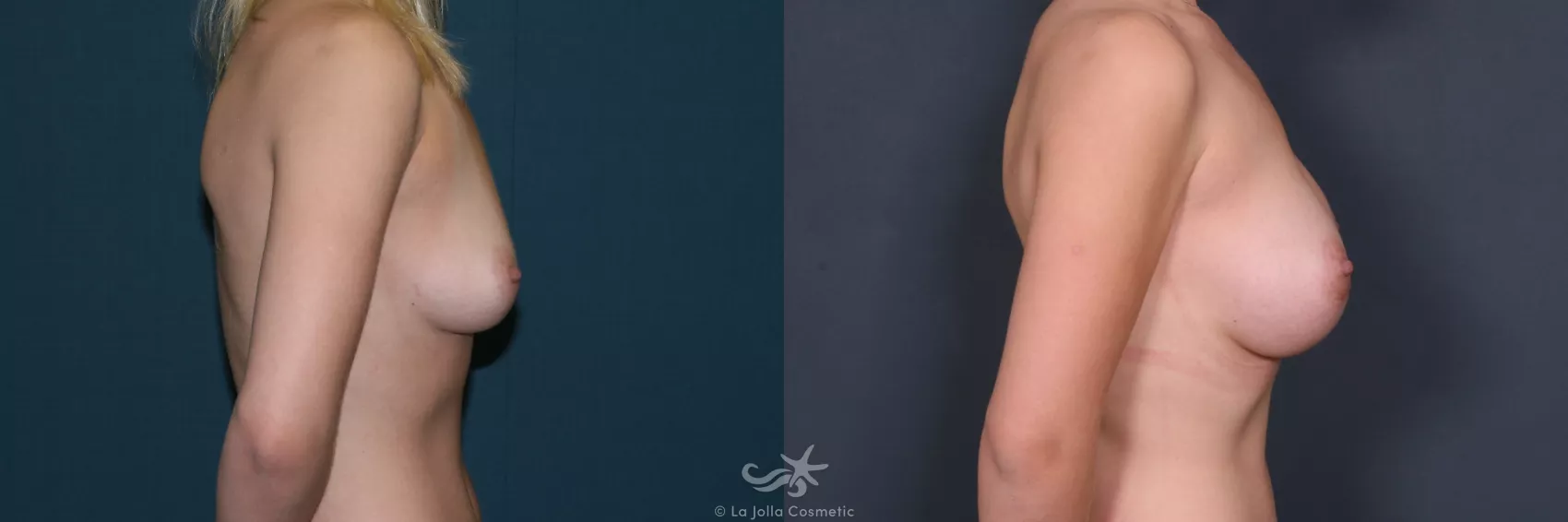 Before & After Breast Augmentation Result 534 Right Side View in San Diego, CA