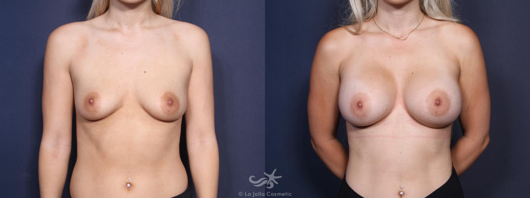 Before & After Breast Augmentation Result 55 Front View in San Diego, CA