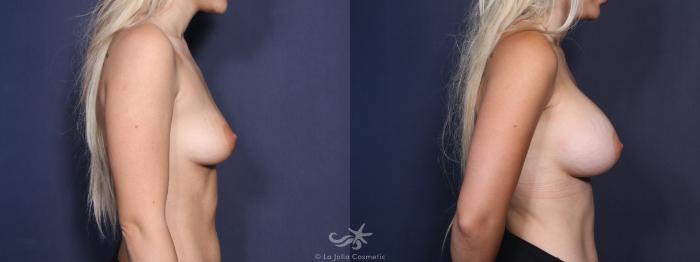 Before & After Breast Augmentation Result 55 Right Side View in San Diego, Carlsbad, CA