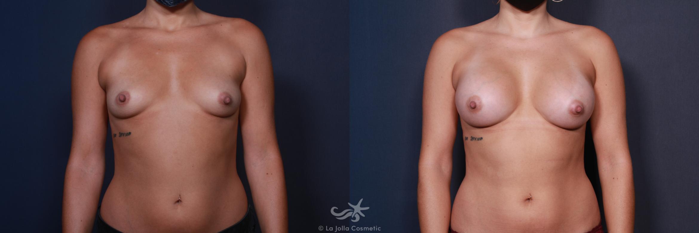 Before & After Breast Augmentation Result 557 Front View in San Diego, CA