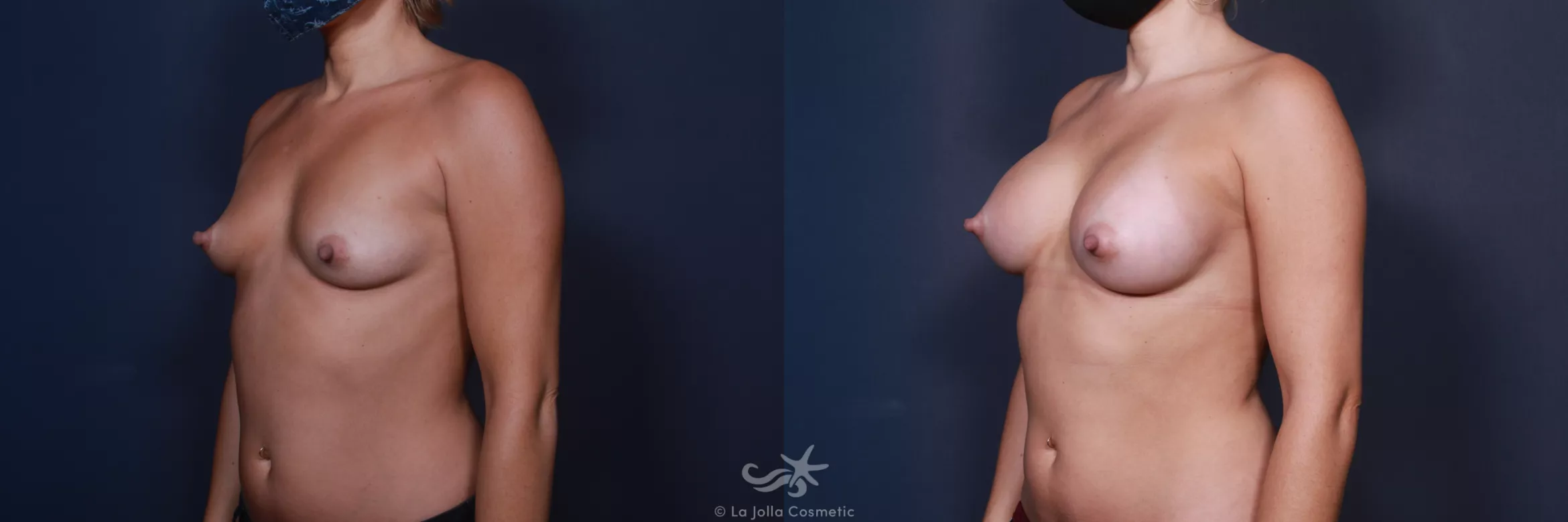 Before & After Breast Augmentation Result 557 Left Oblique View in San Diego, CA
