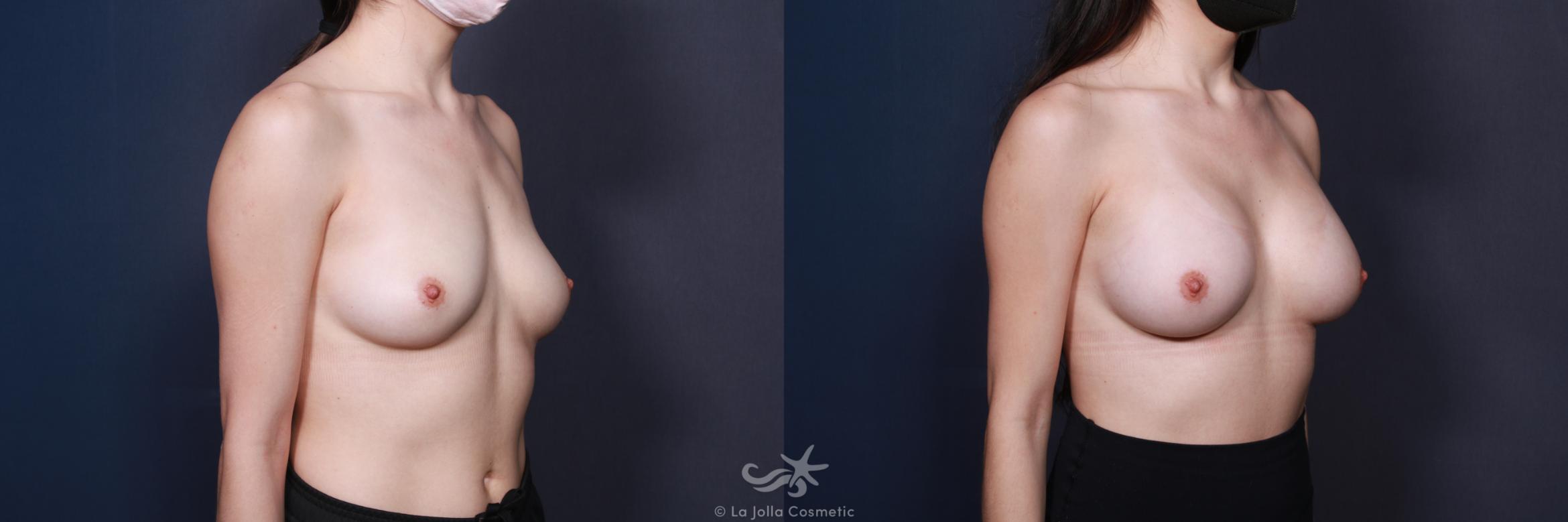 Before & After Breast Augmentation Result 560 Right Oblique View in San Diego, CA