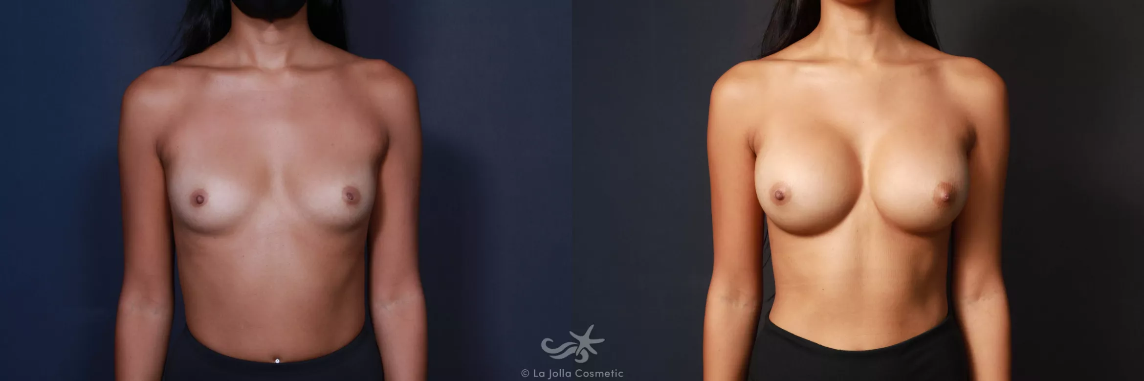 Before & After Breast Augmentation Result 580 Front View in San Diego, CA