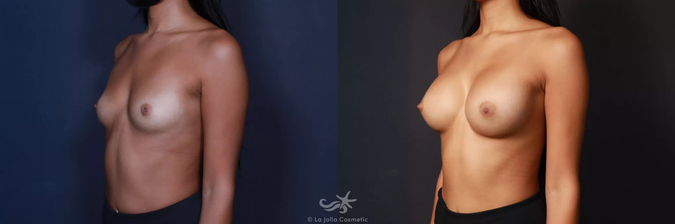 Before & After Breast Augmentation Result 580 Left Oblique View in San Diego, CA