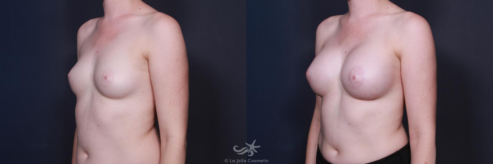 Before & After Breast Augmentation Result 60 Left Oblique View in San Diego, CA
