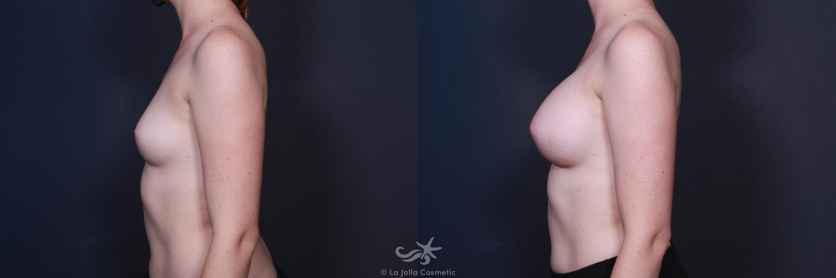 Before & After Breast Augmentation Result 60 Left Side View in San Diego, CA