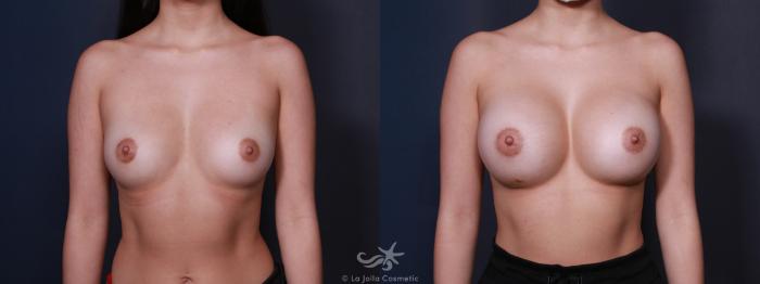 Before & After Breast Augmentation Result 606 Front View in San Diego, Carlsbad, CA