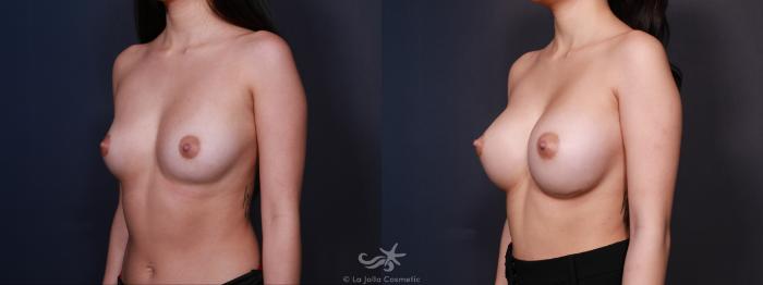 Before & After Breast Augmentation Result 606 Left Oblique View in San Diego, Carlsbad, CA