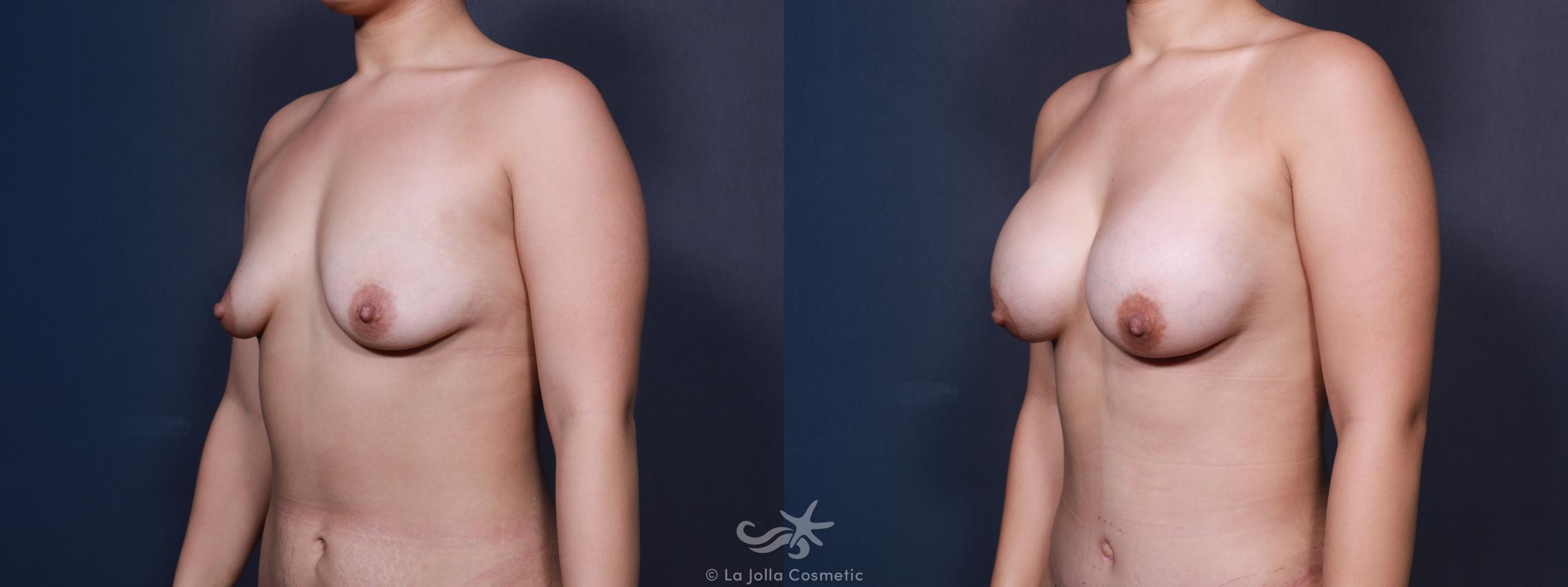 Before & After Breast Augmentation Result 608 Left Oblique View in San Diego, CA