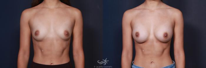 Before & After Breast Augmentation Result 61 Front View in San Diego, Carlsbad, CA