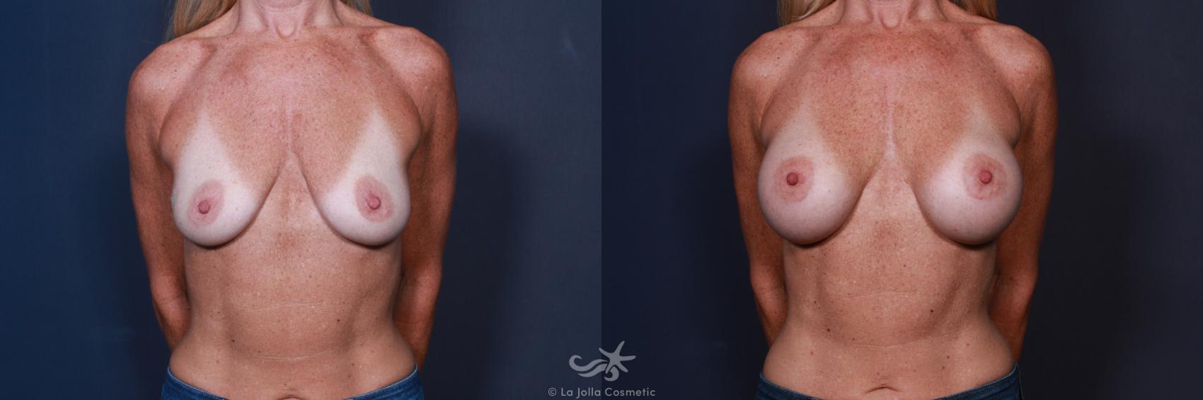 Before & After Breast Augmentation Result 65 Front View in San Diego, CA