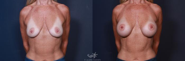 Before & After Breast Augmentation Result 65 Front View in San Diego, Carlsbad, CA