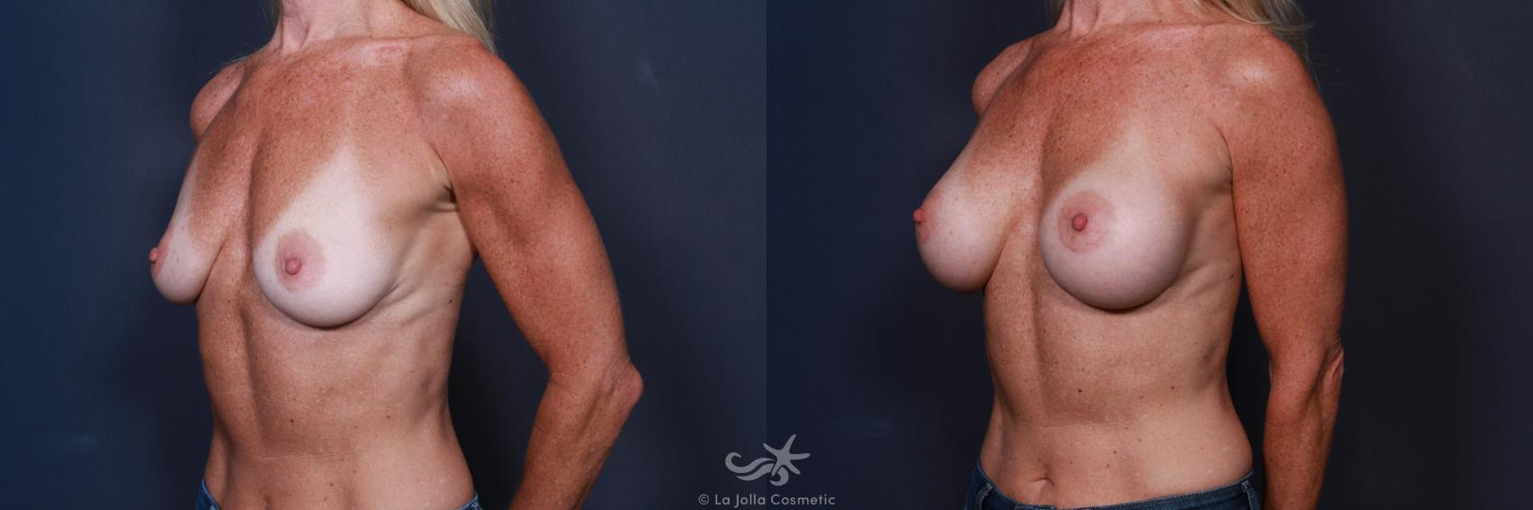 Before & After Breast Augmentation Result 65 Left Oblique View in San Diego, CA