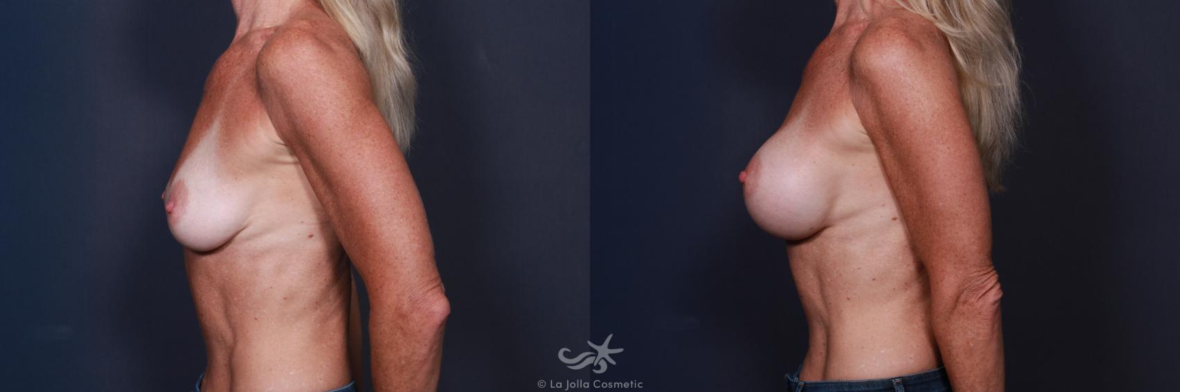 Before & After Breast Augmentation Result 65 Left Side View in San Diego, CA