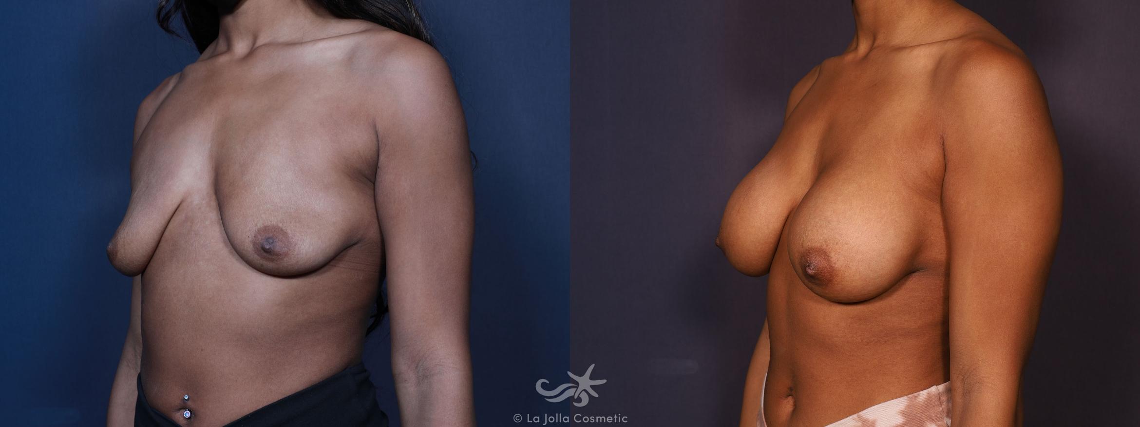 Before & After Breast Augmentation Result 667 Left Oblique View in San Diego, CA