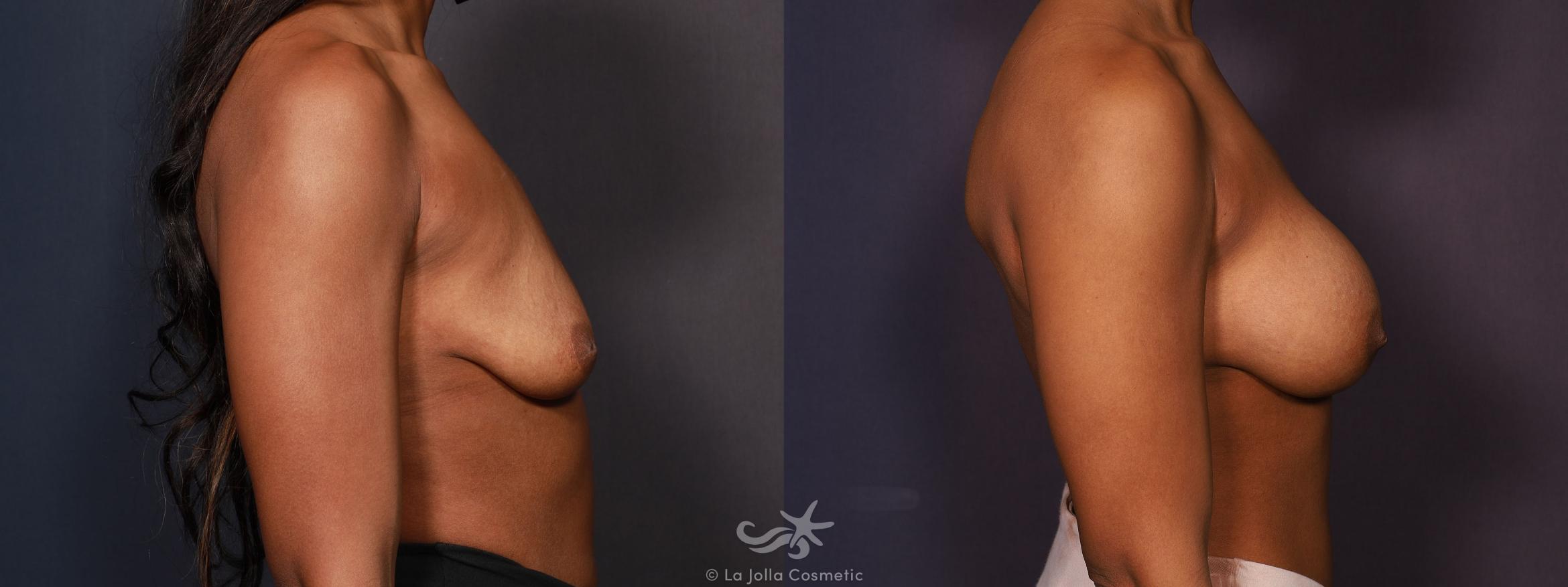 Before & After Breast Augmentation Result 667 Right Side View in San Diego, CA