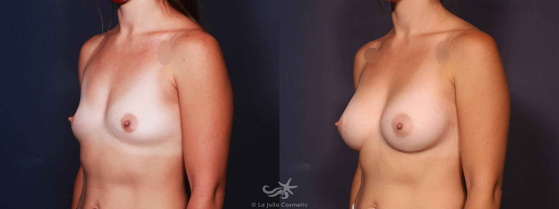 Before & After Breast Augmentation Result 669 Left Oblique View in San Diego, CA