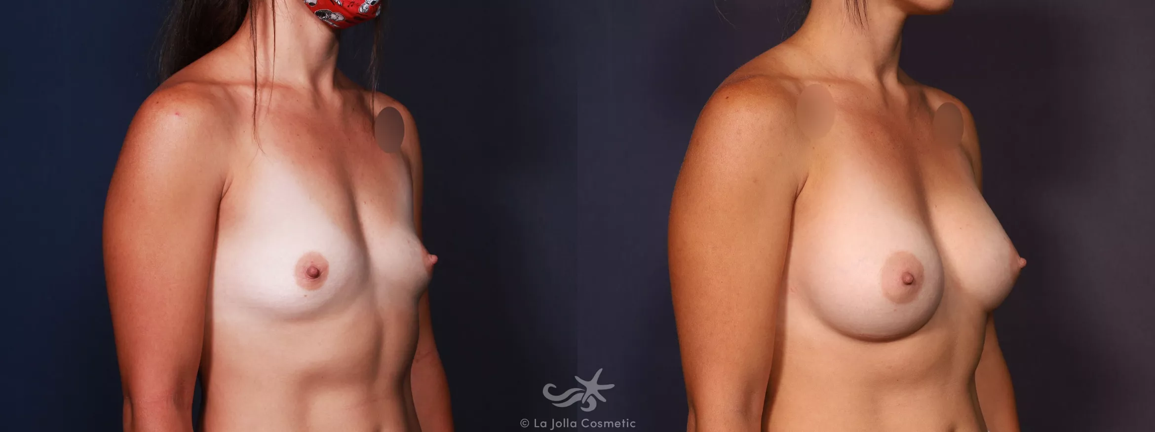 Before & After Breast Augmentation Result 669 Right Oblique View in San Diego, CA