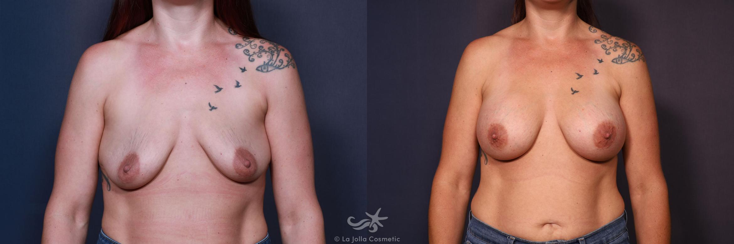 Before & After Breast Augmentation Result 670 Front View in San Diego, CA