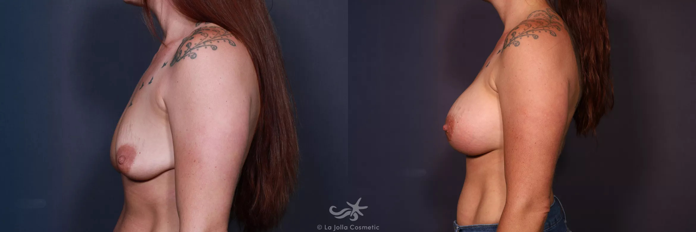 Before & After Breast Augmentation Result 670 Left Side View in San Diego, CA