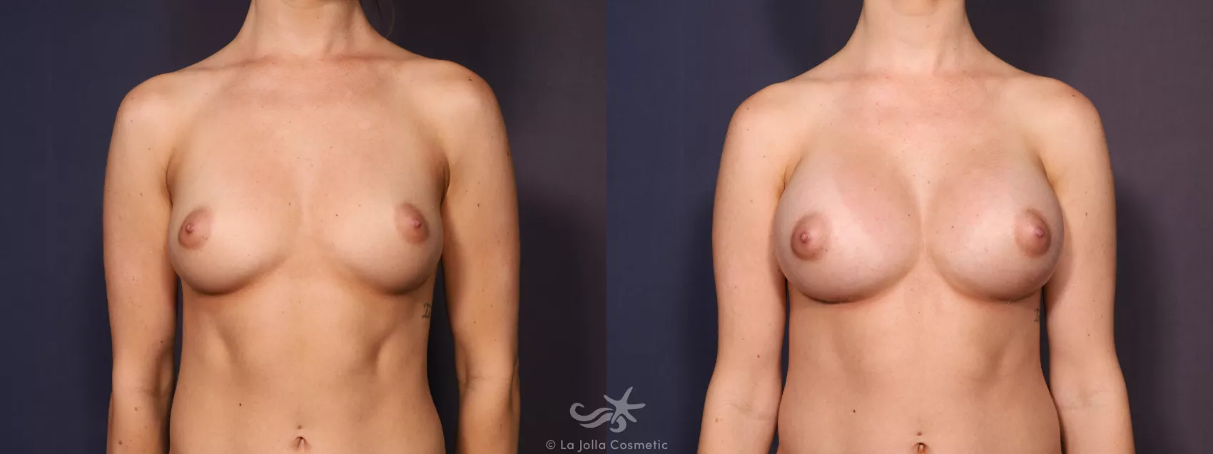 Before & After Breast Augmentation Result 684 Front View in San Diego, CA