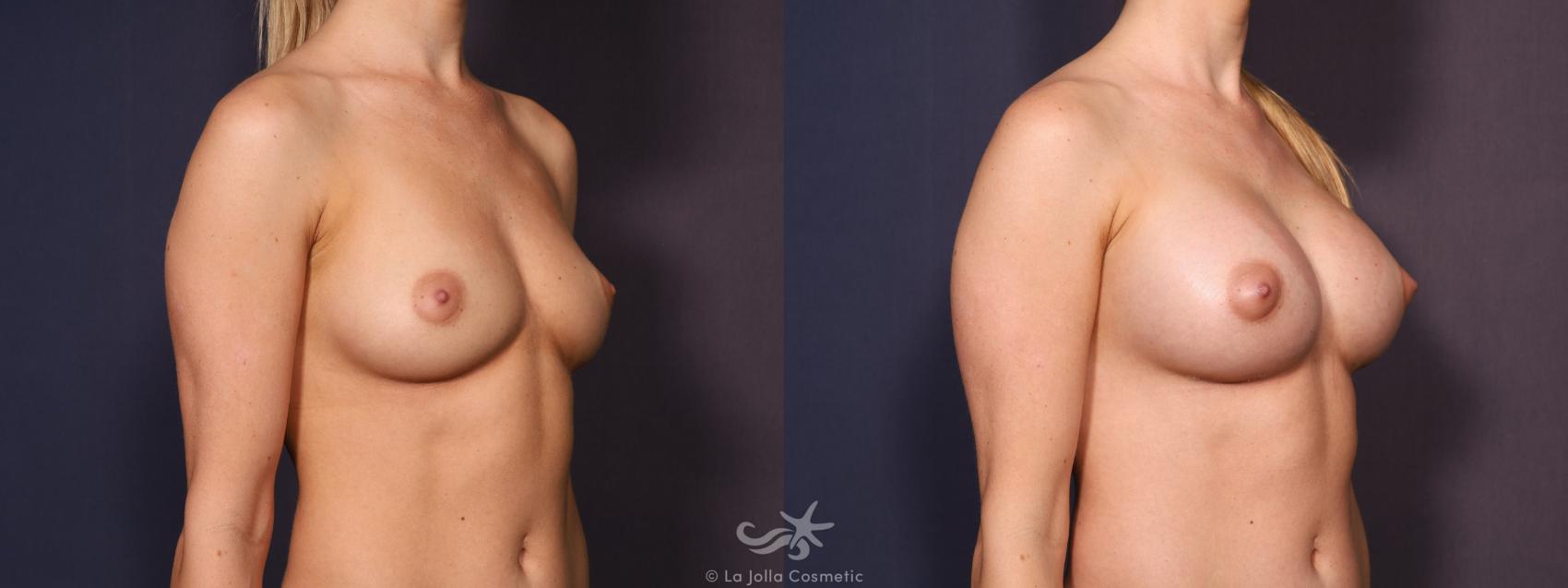 Before & After Breast Augmentation Result 684 Right Oblique View in San Diego, CA