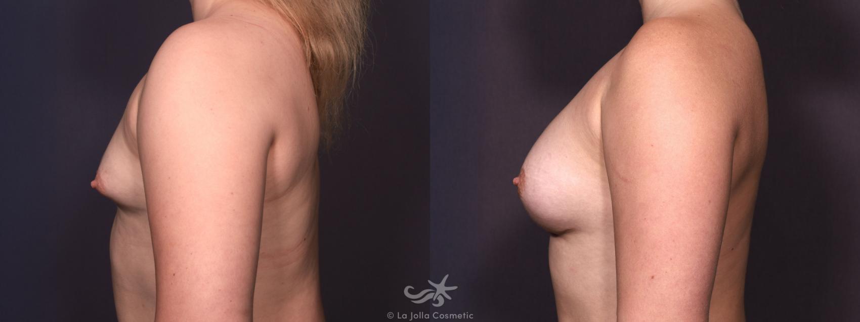 Before & After Breast Augmentation Result 685 Left Side View in San Diego, CA