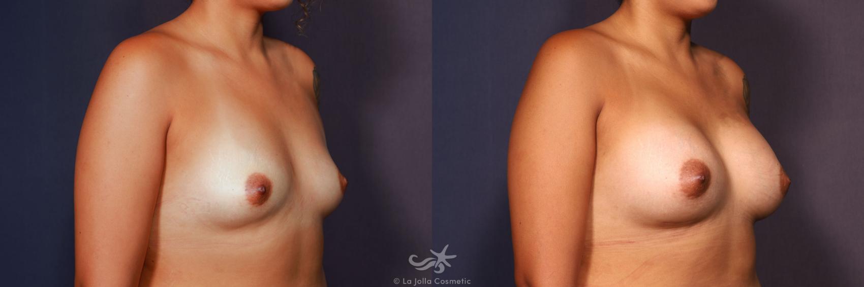 Before & After Breast Augmentation Result 686 Right Oblique View in San Diego, CA