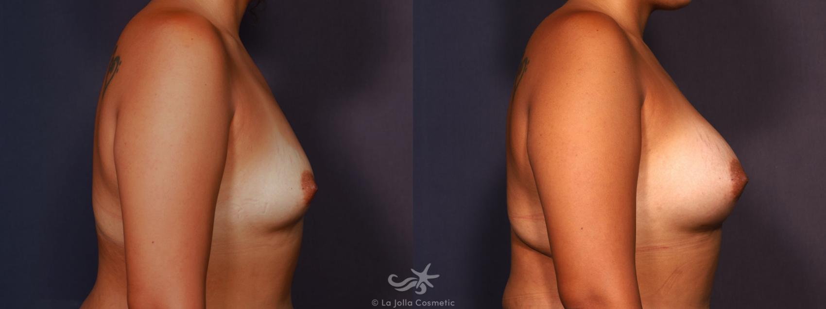 Before & After Breast Augmentation Result 686 Right Side View in San Diego, CA