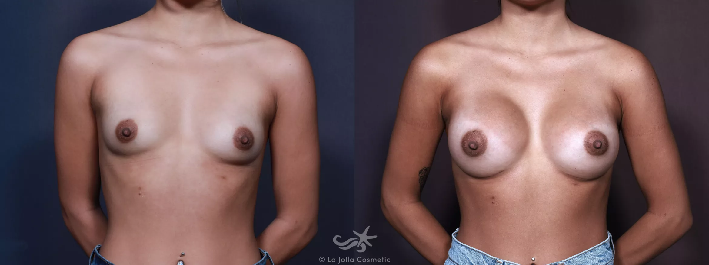 Before & After Breast Augmentation Result 688 Front View in San Diego, CA