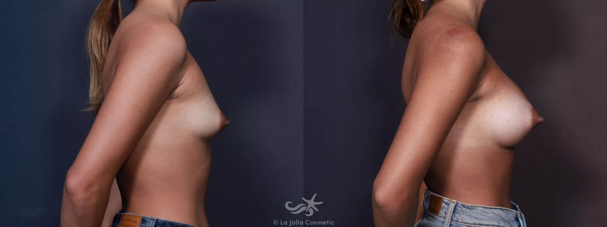 Before & After Breast Augmentation Result 688 Right Side View in San Diego, CA