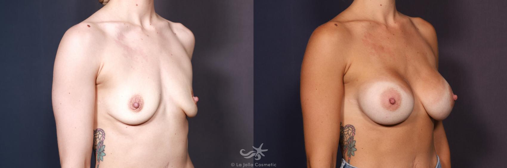 Before & After Breast Augmentation Result 701 Right Oblique View in San Diego, CA