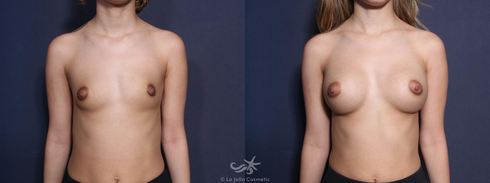 Before & After Breast Augmentation Result 71 Front View in San Diego, CA