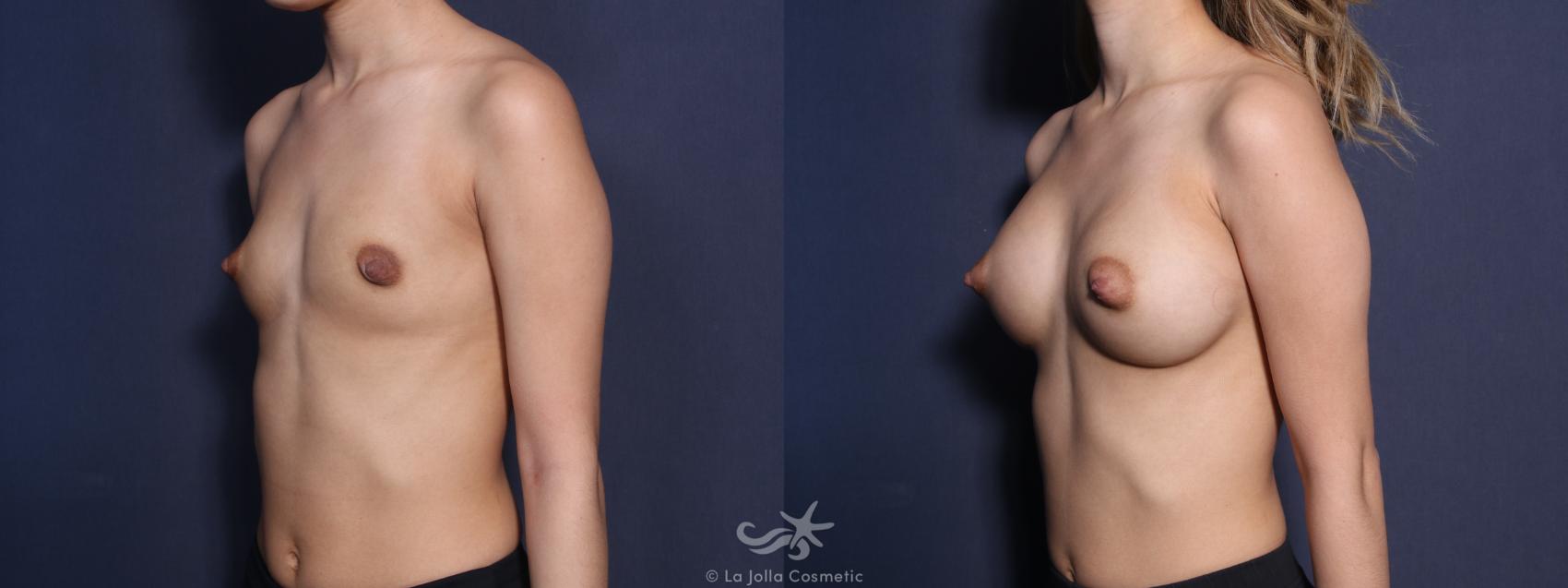 Before & After Breast Augmentation Result 71 Left Oblique View in San Diego, CA