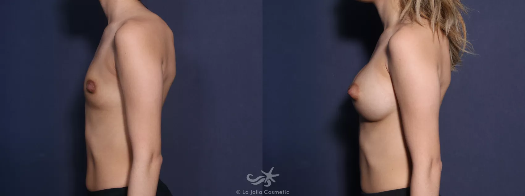 Before & After Breast Augmentation Result 71 Left Side View in San Diego, CA