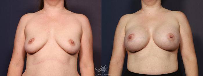 Before & After Breast Augmentation Result 714 Front View in San Diego, Carlsbad, CA