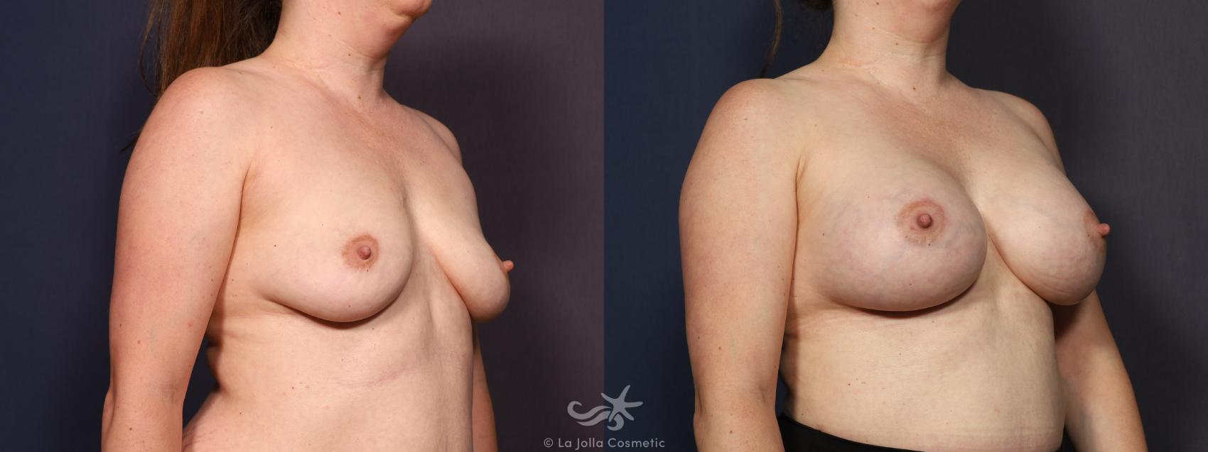 Before & After Breast Augmentation Result 714 Right Oblique View in San Diego, CA
