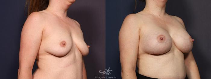 Before & After Breast Augmentation Result 714 Right Oblique View in San Diego, Carlsbad, CA
