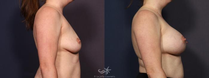Before & After Breast Augmentation Result 714 Right Side View in San Diego, Carlsbad, CA