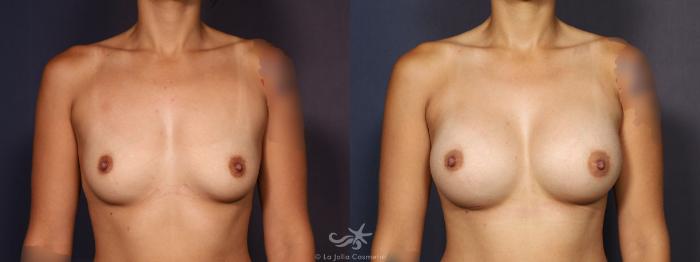 Before & After Breast Augmentation Result 716 Front View in San Diego, Carlsbad, CA