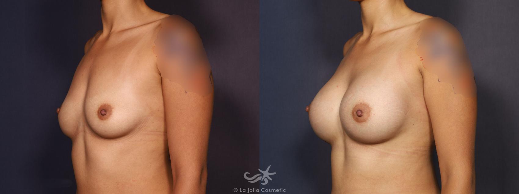 Before & After Breast Augmentation Result 716 Left Oblique View in San Diego, CA