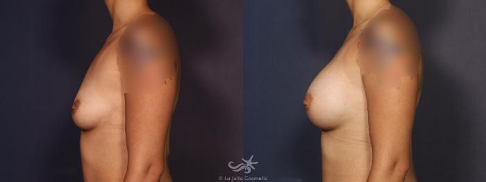 Before & After Breast Augmentation Result 716 Left Side View in San Diego, Carlsbad, CA