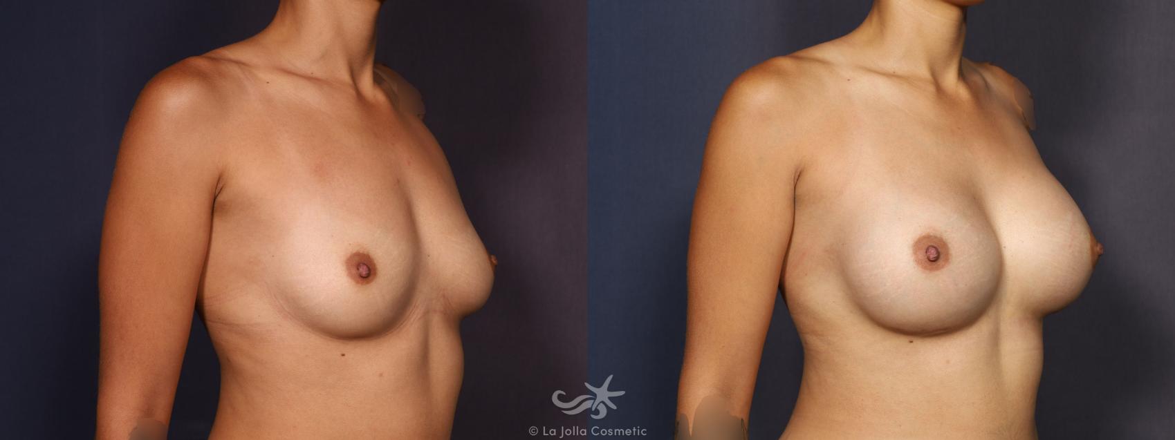 Before & After Breast Augmentation Result 716 Right Oblique View in San Diego, CA