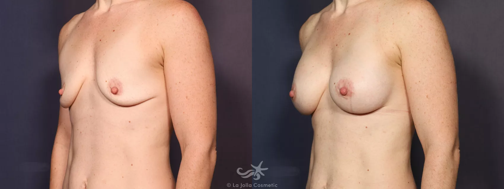 Before & After Breast Augmentation Result 727 Left Oblique View in San Diego, CA